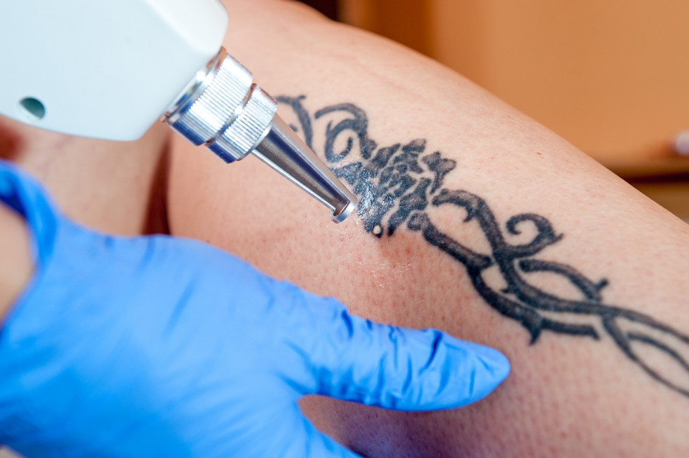 Odstraňovanie tetovania - čo potrebujete vedieť?
