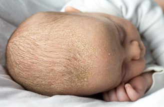 Mliečna chrasta u dojčiat – ako ju rozpoznať a správne liečiť?