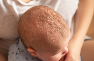 Trápi ťa seborea? TOTO sú návody, vďaka ktorým sa jej konečne zbavíš