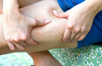 Beauty poradňa GERnétic: Ako odstrániť celulitídu? Preč s ňou!