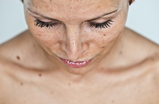 Beauty poradňa GERnétic: Ako predchádzať vzniku pigmentových škvŕn?