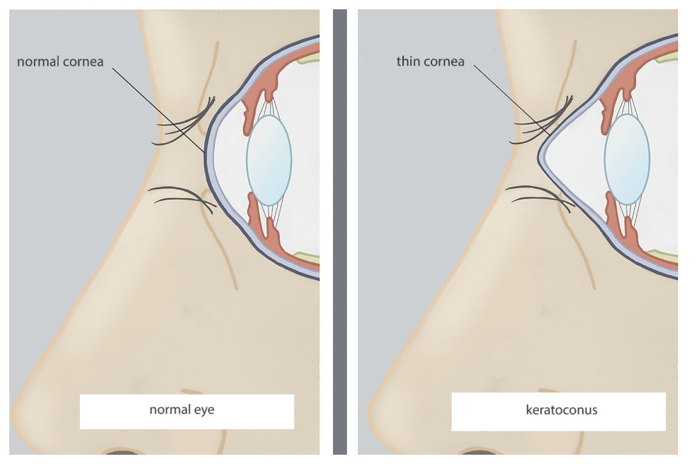 prejavy keratokonusu