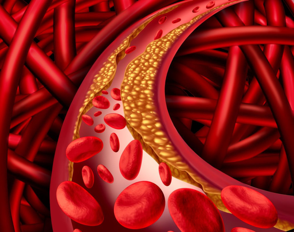 cholesterol, mozog, vplyv cholesterolu na mozog, krv, mrtvica