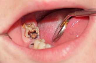 Čo dokáže spôsobiť zubný kaz a zapálené ďasná? Tu je pravda o fatálnych následkoch