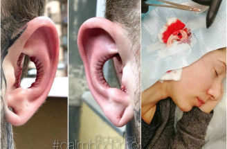 Muž si nechal odrezať z ucha: Aktuálne skrášlovacie trendy naberajú iný rozmer!