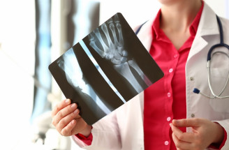 Zápal kostí – kostnej drene, OSTEOMYELITÍDA. Toto sú príčiny, príznaky a spôsoby liečby