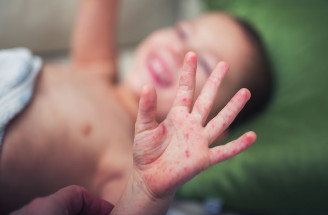 Choroba ruky-nohy-ústa: Vieš, ako pred ňou uchrániť svoje deti?