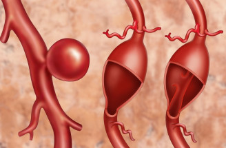 Aneuryzma – ako sa prejavuje výduť aorty či cievy v mozgu?
