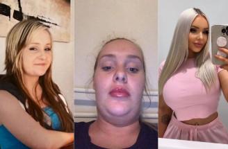 Plastické operácie za státisíce: Čo poviete na premenu tejto 24-ročnej ženy?