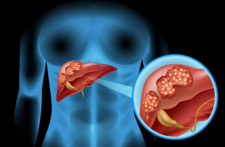 Zákerná rakovina pečene: Spočiatku žiadne prejavy a neskôr zlé prognózy