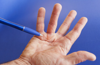 Dupuytrenova kontraktúra – ako sa prejavuje a koho postihuje častejšie?
