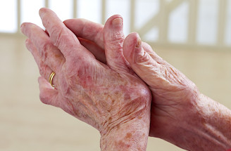 Prevencia artrózy: Nečakaj a urob niečo pre svoje kĺby už dnes!
