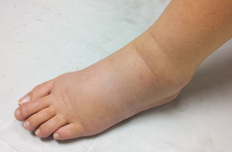 Zadržiavanie vody v tele: Máme užitočné rady, ako sa ho zbaviť