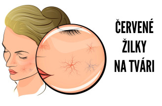Červené žilky – ako s nimi bojovať?