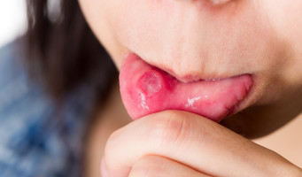 Ako vyliečiť afty v ústach? Poznáš tieto najúčinnejšie prírodné prostriedky?