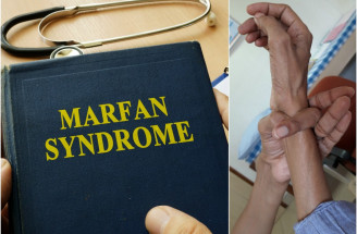 Čo je Marfanov syndróm? Pozor, poukazujú naň tieto príznaky!