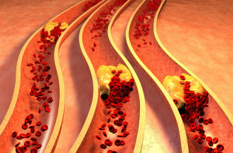 Ateroskleróza je postrachom pre naše cievy. Ako sa pred ňou chrániť?