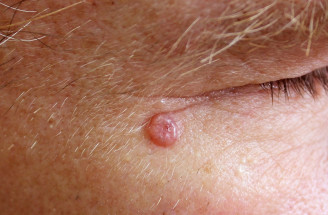 Bazalióm – najčastejší kožný nádor. Čo zvyšuje riziko jeho vzniku?