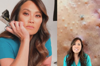 Slávna lekárka Pimple Popper radí: Ako odstrániť čierne bodky?