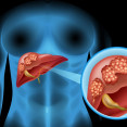 Zákerná rakovina pečene: Spočiatku žiadne prejavy a neskôr zlé prognózy