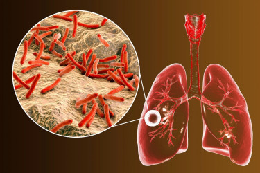 Tuberkulóza – aké sú príčiny, prejavy, liečba a prevencia choroby?