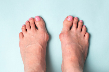 Toto sú časté príčiny vybočeného palca. Aká je však prevencia?