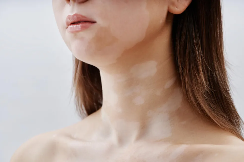 vitiligo
