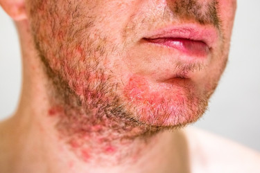 Seboroická dermatitída: Čo môže spustiť rozvoj ochorenia?