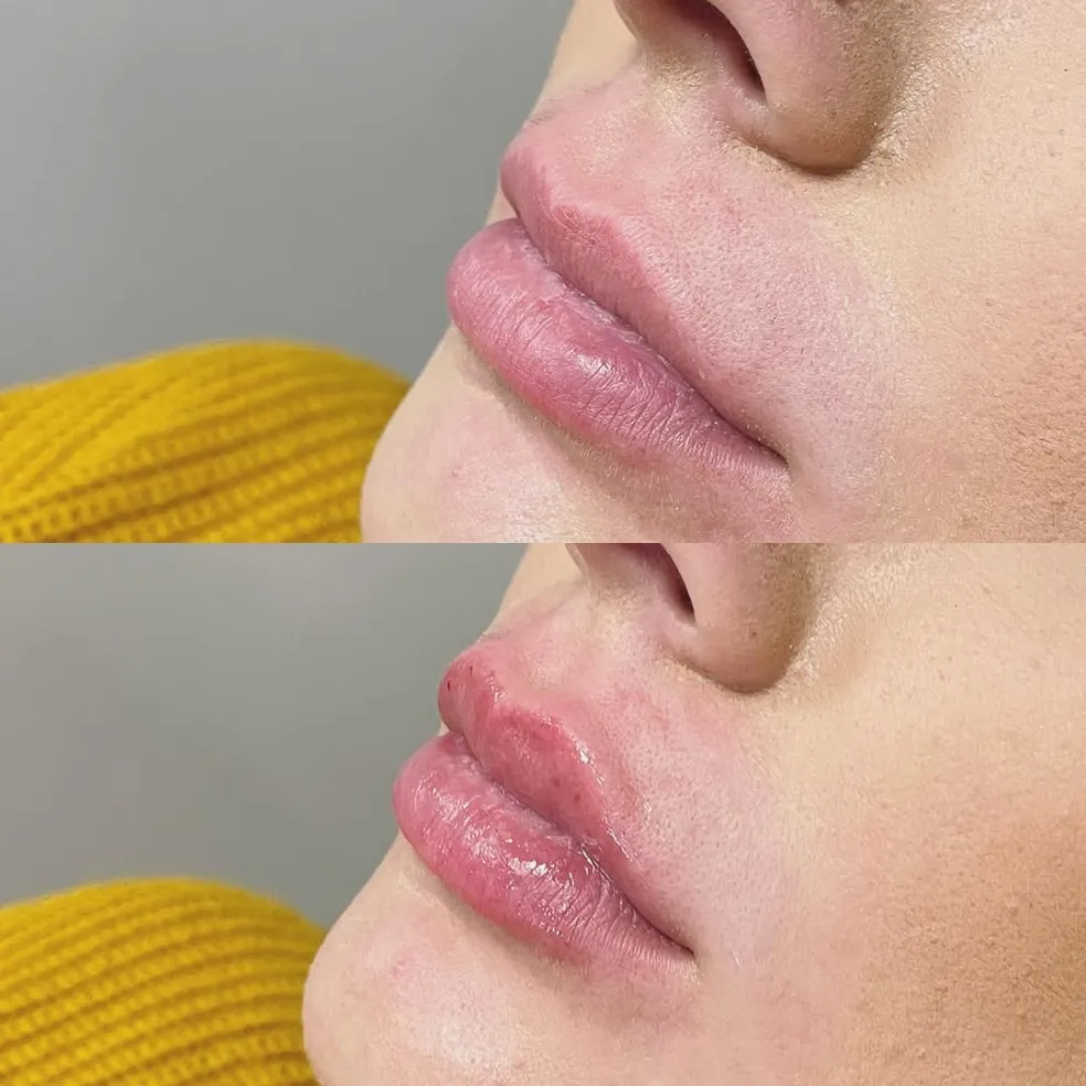 čo je lip flip procedúra