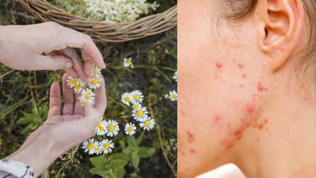 Akné a bylinky idú dokopy! Ktoré odporúča tradičná medicína?