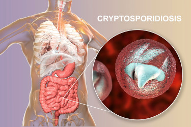 Nepríjemná parazitárna choroba: Aké ťažkosti spôsobuje kryptosporidióza?