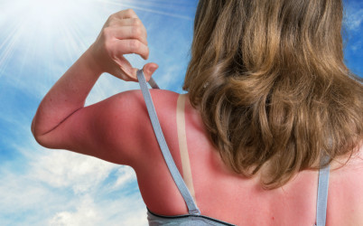 Prvá pomoc pri spálení? Vyskúšaj top domáce lieky na spálenú pokožku!