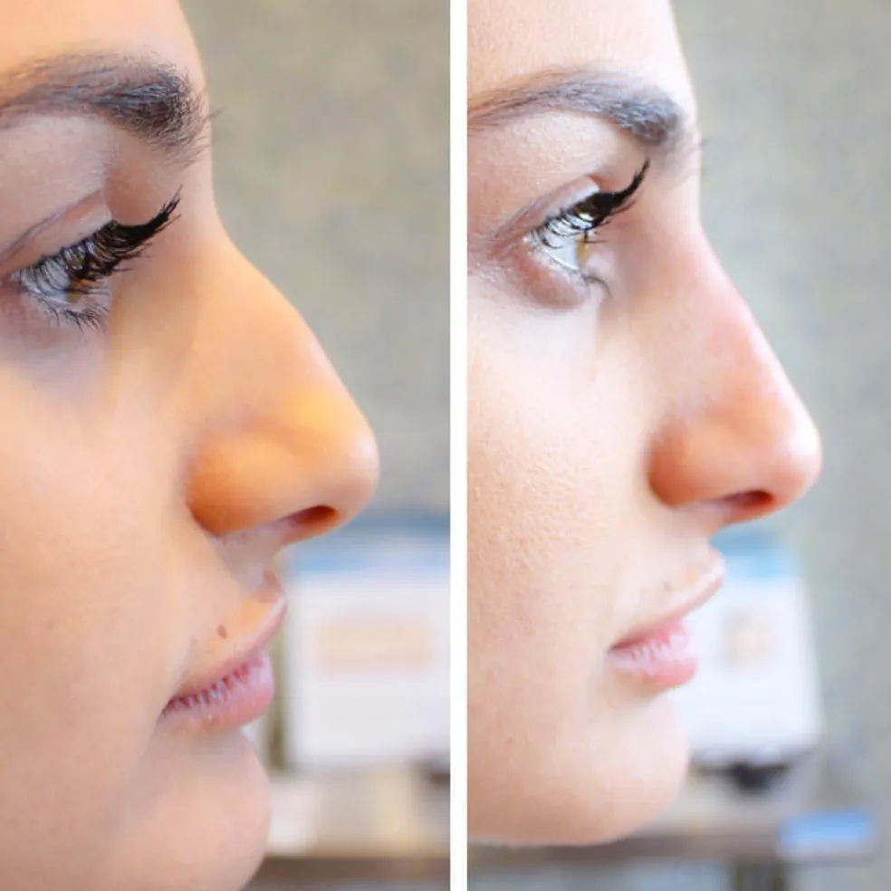 rinoplastika