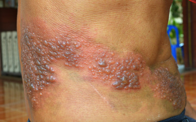 Pásový opar (herpes zoster): Nauč sa rozpoznať príznaky včas!
