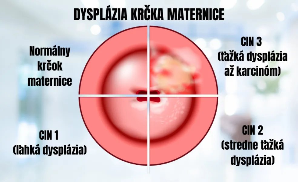 Stupne závažnosti dysplázie krčka maternice