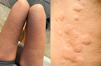 Žihľavka z pohybu: Čo robiť, keď telo reaguje na šport alergiou?