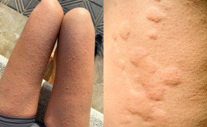 Žihľavka z pohybu: Čo robiť, keď telo reaguje na šport alergiou?