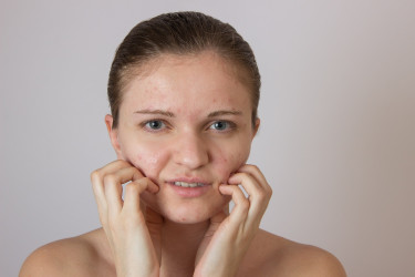 Beauty poradňa GERnétic: Ošetrenie problematickej pleti