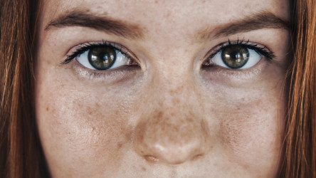 Beauty poradňa GERnétic: Ako na pigmentové škvrny?