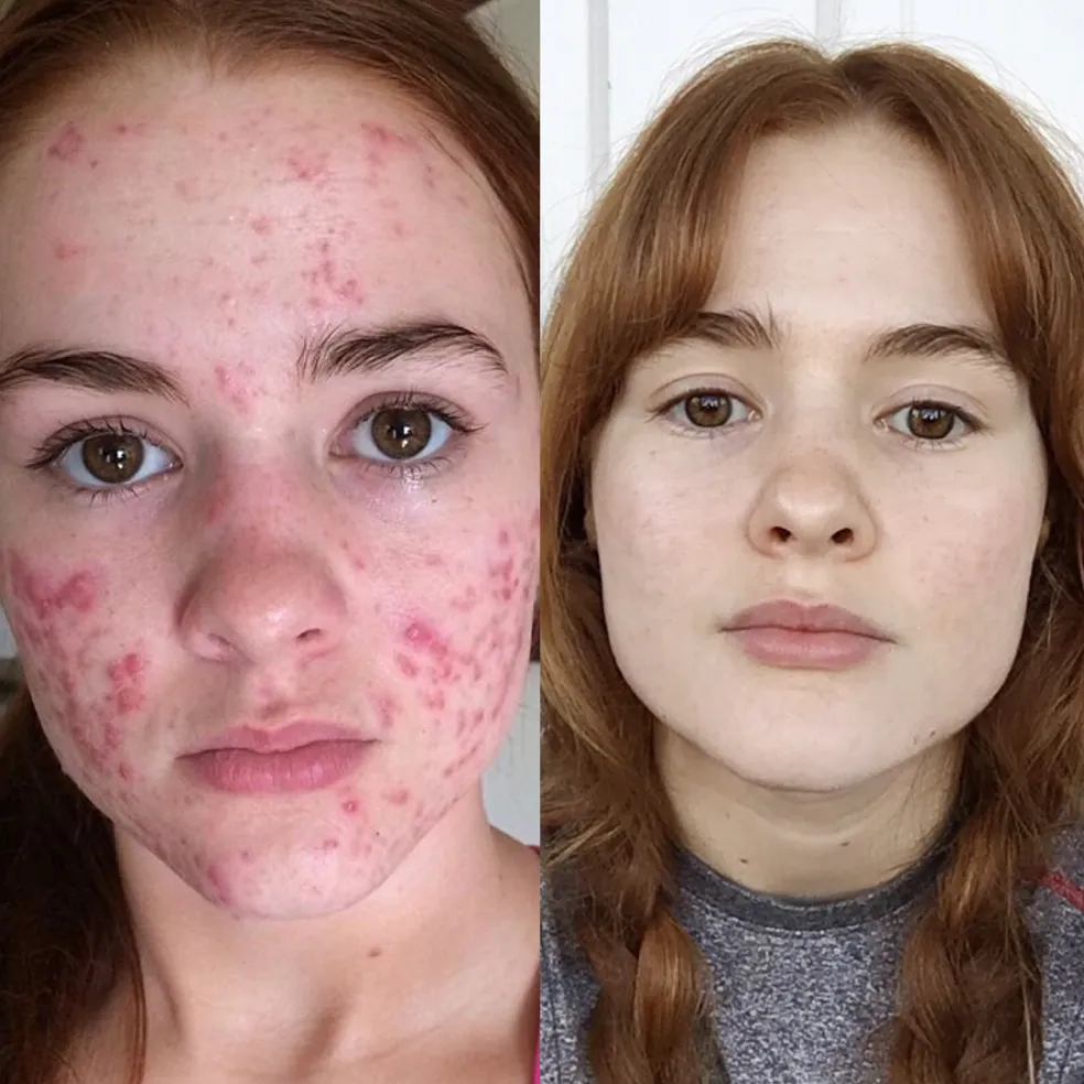 liečba akné Accutane