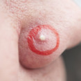 Neviditeľné, no bolestivé vyrážky v nose: Ako sa ich zbaviť?
