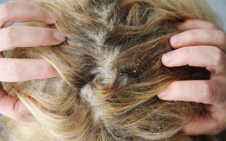 Ochorenia vlasovej pokožky