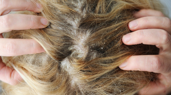 Ochorenia vlasovej pokožky: Takto si s nimi hravo poradíš!