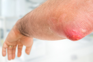 Vieš, čo je to furunkul? Zisti, ako sa toto ochorenie prejavuje!