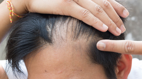 Vieš, čo je to alopécia? Zisti, ako sa prejavuje toto ochorenie!