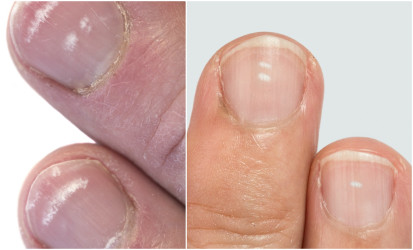Biele škvrny na nechtoch – prečo vznikajú a čo znamenajú?