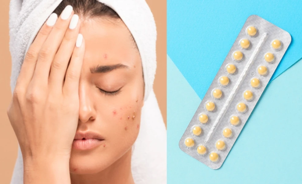 vplyv hormonálnej antikoncepcie na pleť