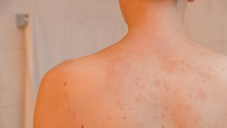 Čo je Heraldova škvrna (pityriasis rosea)? Kožné ochorenie sa môže objaviť u kohokoľvek!