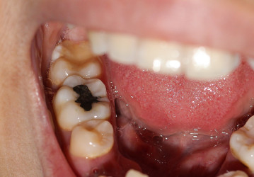 Zubný amalgám: Je naozaj nebezpečný? Prečo by sa nemal používať?