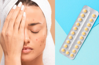 Ako hormonálna antikoncepcia ovplyvňuje pleť? Prináša pozitíva i negatíva!